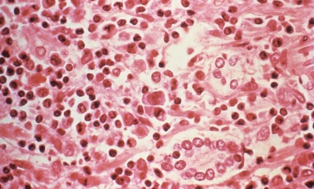 A micrographic study of liver tissue seen from a Hantavirus pulmonary syndrome (HPS) patient seen in this undated photo obtained by Reuters, July 6, 2017. Centers for Disease Control and Prevention/Handout via REUTERS