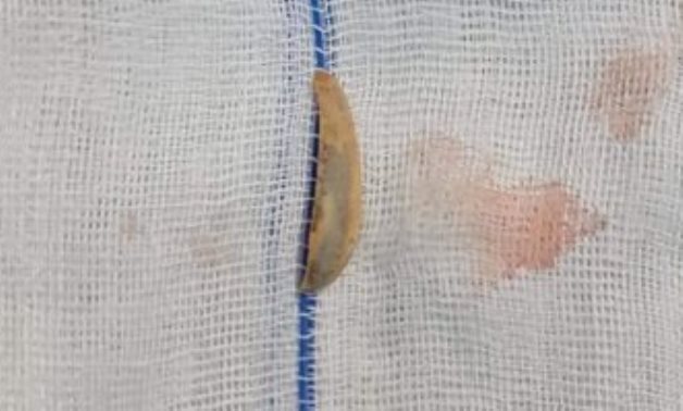 Pumpkin seed shell extracted from child's trachea 