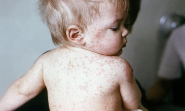 Young boy with measles – Wikimedia Commons 