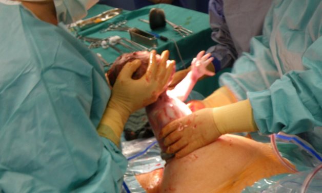 Pull out of the child at Caesarian section- CC via Wikimedia