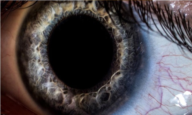 Over five million people across the world are patients affected by this condition, which causes lesions on the retina.