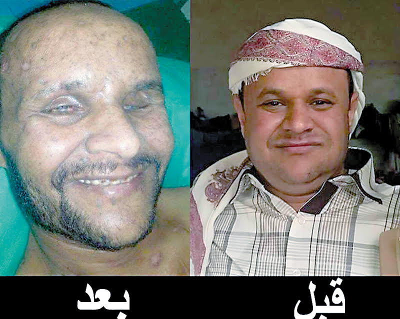 أحد المختطفين عذبه الحوثى حتى أفقده البصر