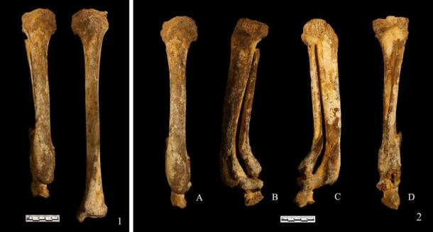 These leg bones found in a 3,000-year-old grave in China show evidence of foot amputation as punishment according to the latest research. ( South China Morning Post )