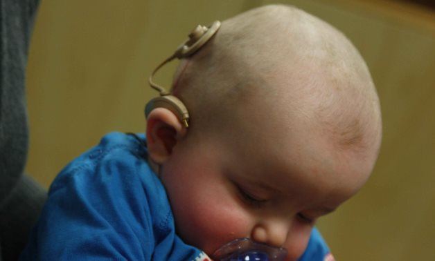 Infant with cochlear implant - cc via Wikimediacommons
